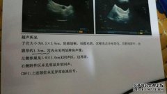 [无回声差异的囊性回声]