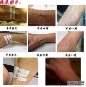 创伤缝合后疤痕的治疗