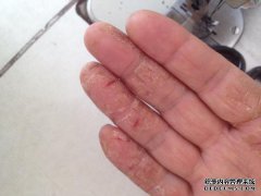 如果脚很干怎么办？